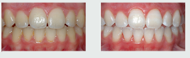 לפני- שיניים צהובות, אחרי הלבנה בשיטת ברייט סמייל - שיניים לבנות