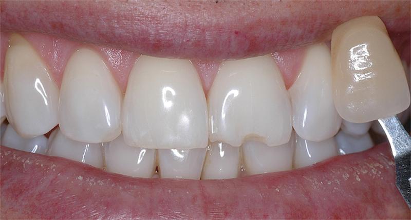 הלבנת שיניים - השיניים לאחר ההלבנה שלידן 