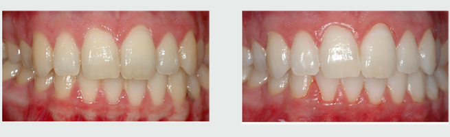 הלבנת שיניים ביתית - לפני ואחרי