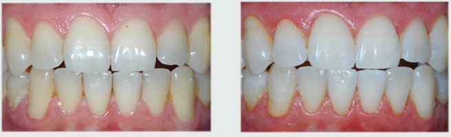 שיניים לבנות אחרי הלבנת שיניים ותמונה של השיניים לפני ההלבנה