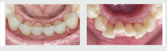יישור שיניים למבוגרים invisalign - לפני ואחרי