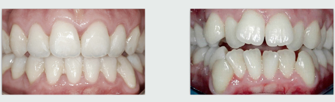 יישור שיניים באמצעות גשר חרסינה - לפני ואחרי