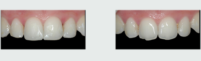 ציפוי שיניים ליצירת שיניים ישרות לפני ואחרי