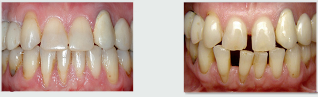 סגירת רווחים בשיניים בעזרת יישור שיניים - לפני ואחרי