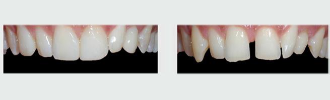 ציפוי שיניים לסגירת רווחים בין השיניים