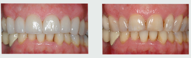 ציפוי חרסינה לשיניים לפני ואחרי