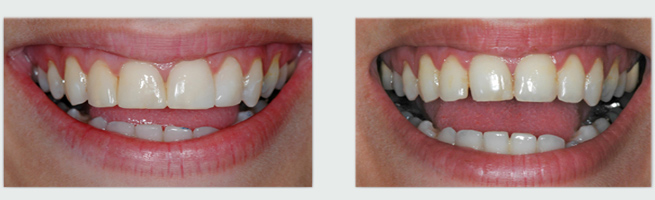 ציפוי לשיניים - לפני ואחרי