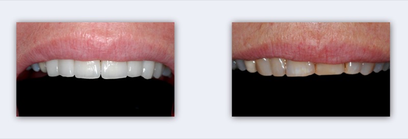 הלבנת שיניים: לפני ואחרי