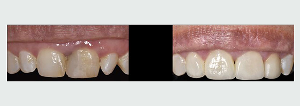 לפני ואחרי: ציפוי שיניים