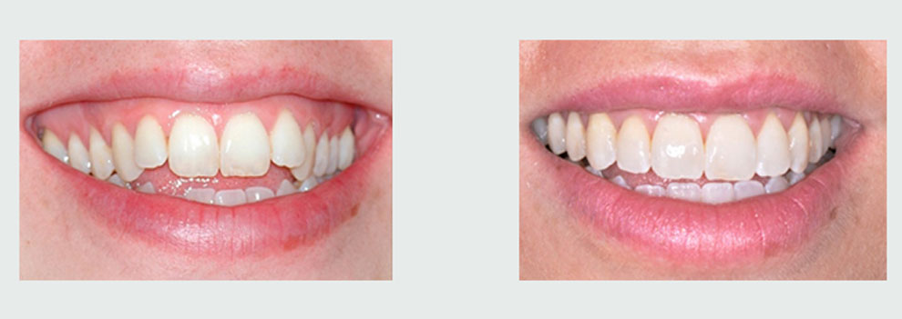 יישור שיניים למבוגרים: לפני ואחרי