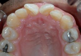 שיניים עקומות קדמיות