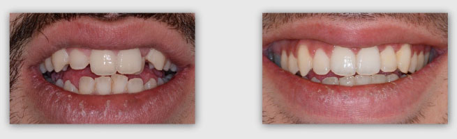 יישור שיניים שנראות גדולות לפני ואחרי