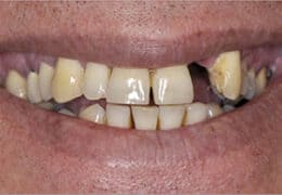 תיקון השלמת שן חסרה